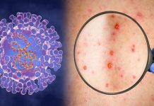 Un nou caz de variola maimuței