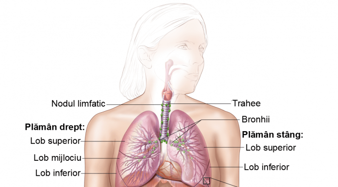 Cancerul bronhopulmonar