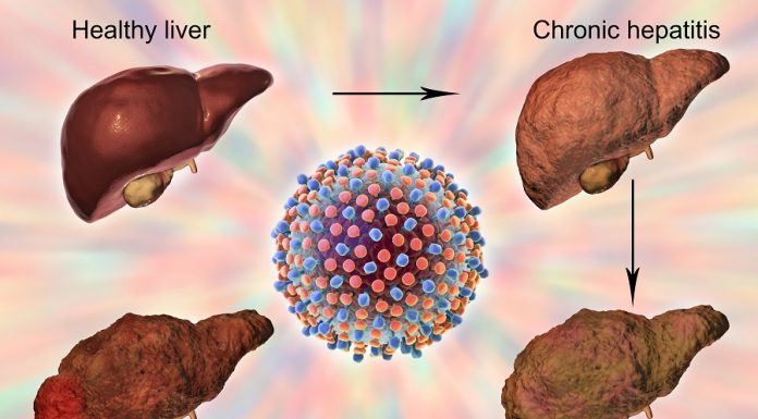 Hepatita C, boala care nu are simptome până când ajunge în stadii avansate