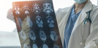 A suferit un grav accident vascular la 31 de ani. Medic: A fost cea mai tânără pacientă pe care am trombolizat-o