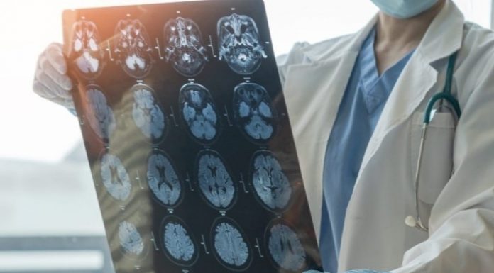 A suferit un grav accident vascular la 31 de ani. Medic: A fost cea mai tânără pacientă pe care am trombolizat-o