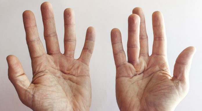 Ce este boala Dupuytren și cum se poate trata