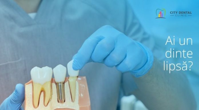 Implanturi Dentare: Calitate și Confort la City Dental Clinic Târgu Jiu