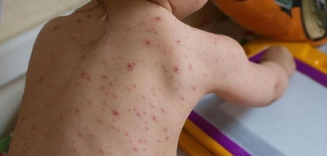 18 cazuri de rujeolă în Gorj