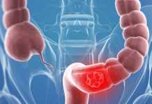 Câți gorjeni suferă de cancer colorectal