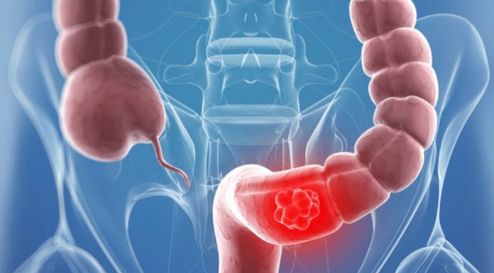 Câți gorjeni suferă de cancer colorectal