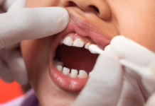 Tot ce trebuie să știi despre importanța fluorizării dentare la copii