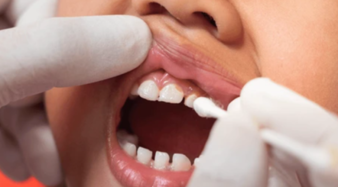 Tot ce trebuie să știi despre importanța fluorizării dentare la copii