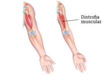 Distrofia musculară Duchenne – cea mai frecventă boală neuromusculară ereditară