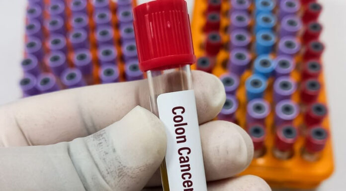 Acces gratuit la testări pentru cancerul colorectal