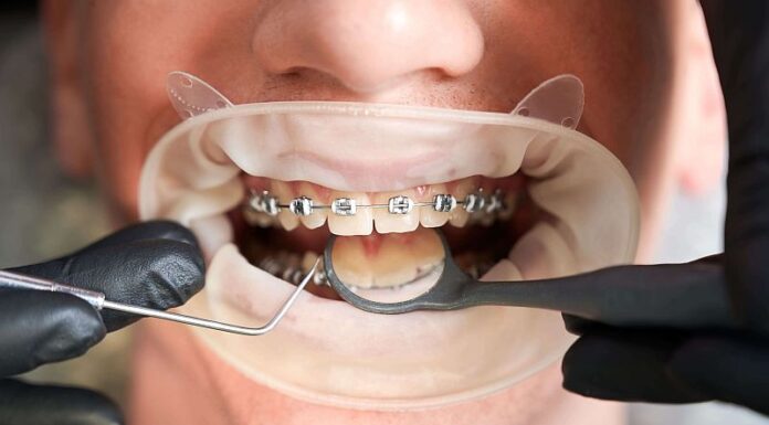 Aparatul dentar: Cât durează tratamentul și ce rezultate poți aștepta