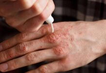 Primul caz de lepră în România, după 44 de ani