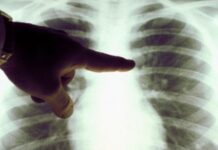 Mii de radiografii la Dispensarul TBC de la Târgu Jiu