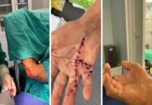 Chirurgie reconstructivă la Spitalul Județean. Doi pacienți au beneficiat de intervenții pentru redarea funcției mâinii