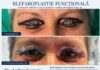Blefaroplastie realizată la Spitalul Județean. Intervenția a fost necesară pentru îmbunătățirea vederii