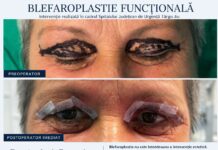 Blefaroplastie realizată la Spitalul Județean. Intervenția a fost necesară pentru îmbunătățirea vederii