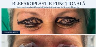 Blefaroplastie realizată la Spitalul Județean. Intervenția a fost necesară pentru îmbunătățirea vederii